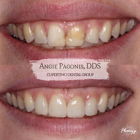 angie pagonis|Cosmetic Dentist Cupertino CA, Dental Implants, iTero Cupertino。